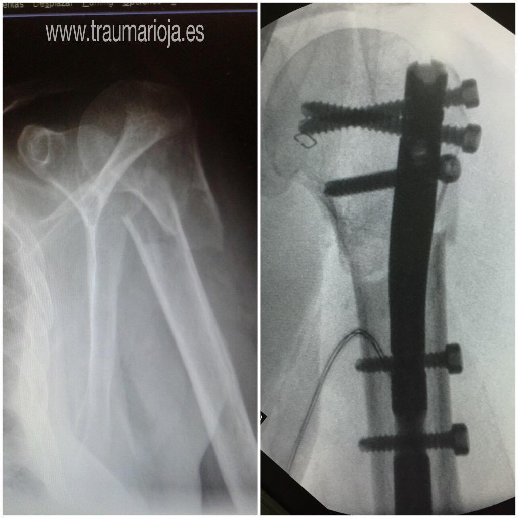Sistema de clavo humeral MultiLoc Multiplique sus opciones #49 Sistema de clavo humeral MultiLoc Multiplique sus opciones