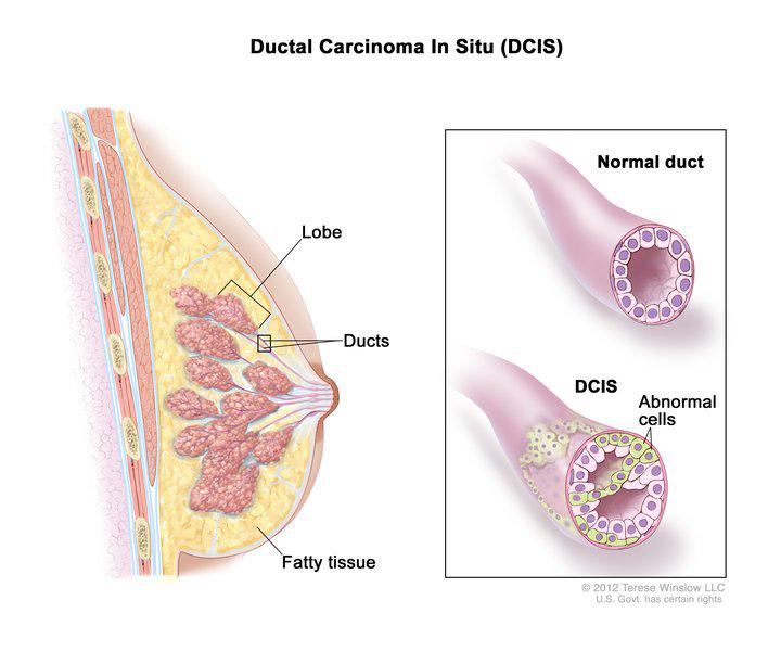 theNCI's tweet photo. DCIS is a noninvasive condition in which abnormal cells are in the lining of a breast duct: http://t.co/fKBN3mGMaH http://t.co/z0o34lNrtR