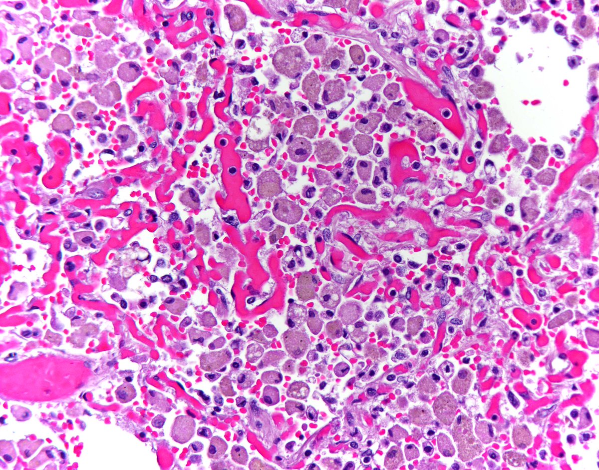 Death Under Glass On Twitter Hemosiderin Laden Macrophages In Alveoli Due To Dilated Cardiomyopathy 1st Dx Ed At Autopsy Pathologists Histology Http T Co 3ztccevj4u