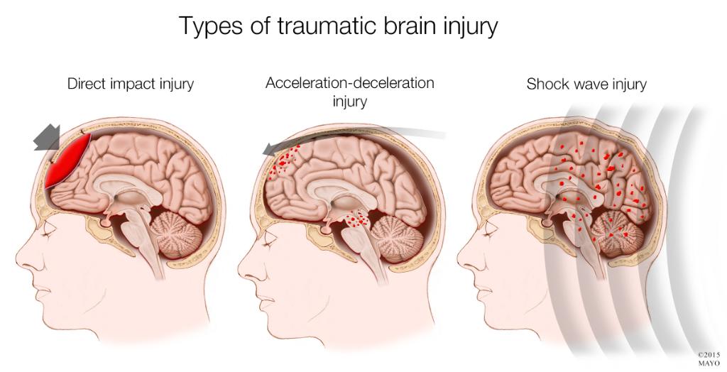 Traumatic Brain Injury Brain Injury Association Of Virginia traumatic-brain-injury-brain-injury-association-of-virginia