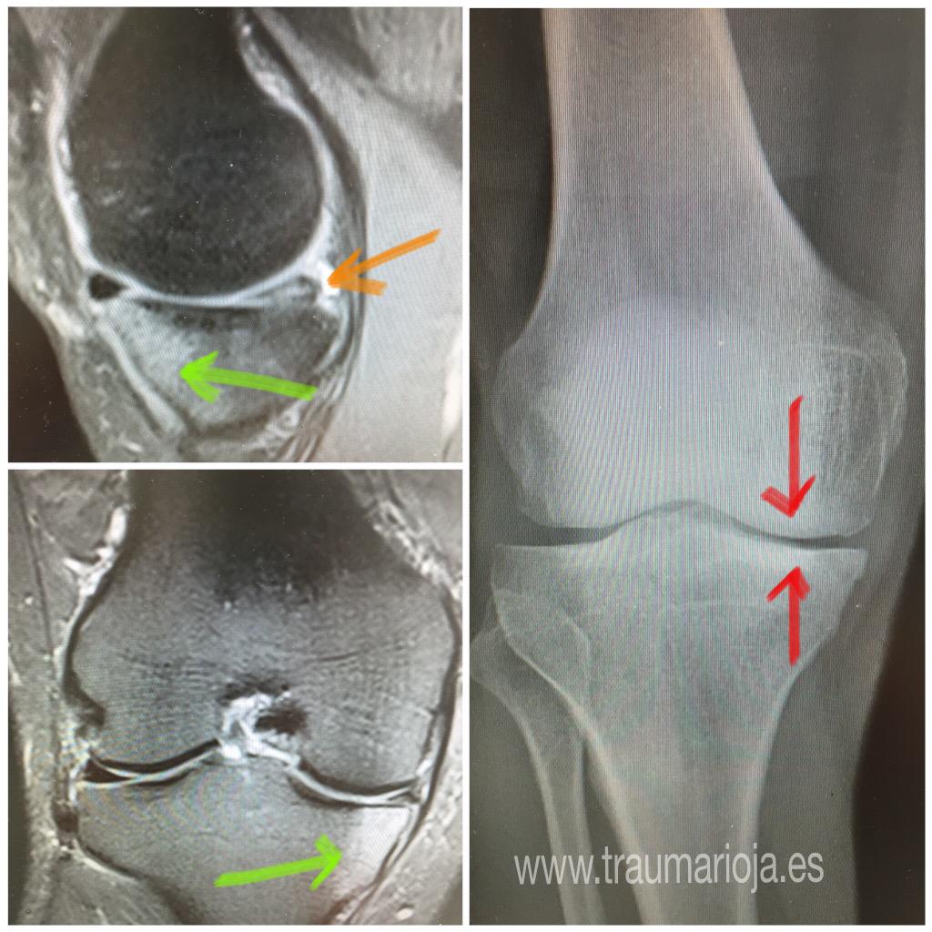 Traumatología on Twitter "Artrosis compartimento interno. Pinzamiento