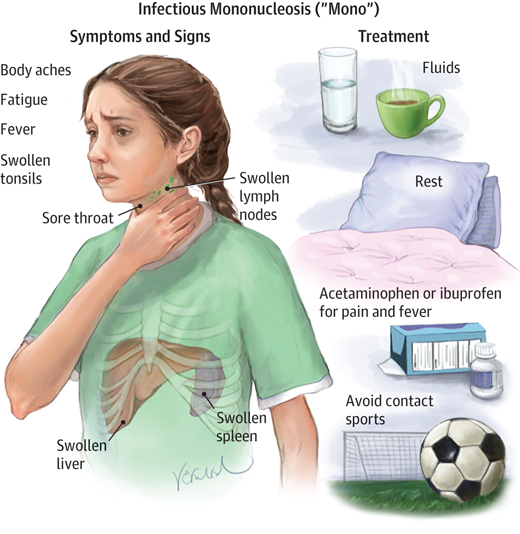 About Mono (Infectious Mononucleosis)