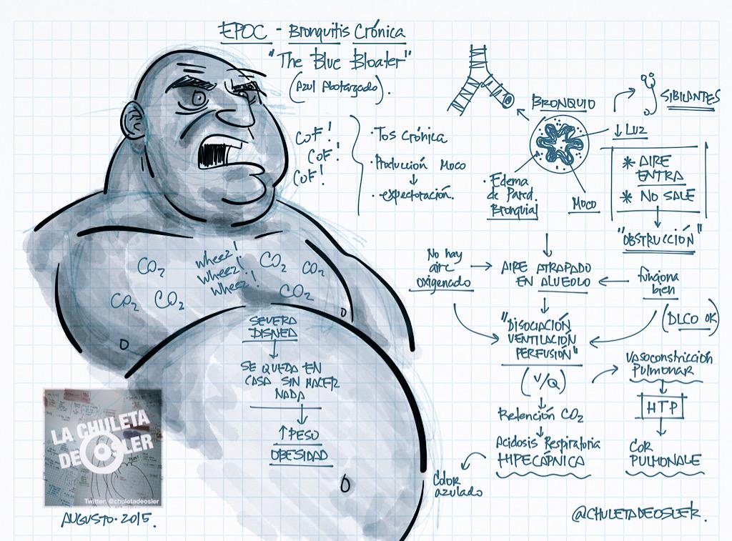 chuletadeosler's tweet photo. #EPOC Bronquitis Crónica "TheBlueBloater" #medicina #neumologia @IlindelatorreMD @DrMacarron @SandraSanchezMR http://t.co/7EU9vSFOut