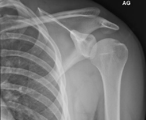 JohnmanStyle's tweet photo. Normal shoulder on the left, mine on the right #acseparation #tornligament #snowboarding http://t.co/uMXakPOIuZ