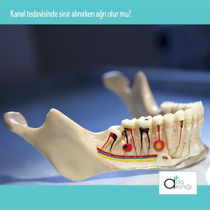 Kanal tedavisinde çok akut durumlar dışında sinir alınırken ağrı olmaz. #dişbilgi #dişsağlığı #kanaltedavisi #aplus