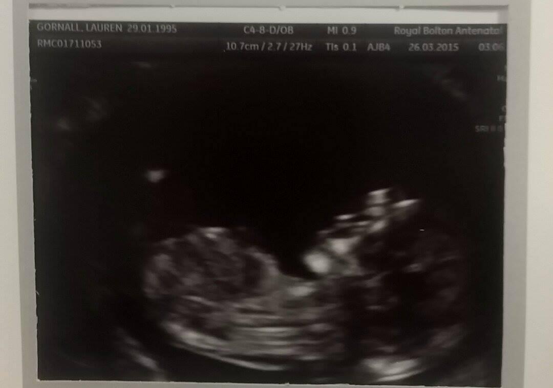 AdenWood's tweet photo. 12 week 4 days... healthy baby :) love you @laurengornallx #naughtybaby http://t.co/SfyYeTB0tW