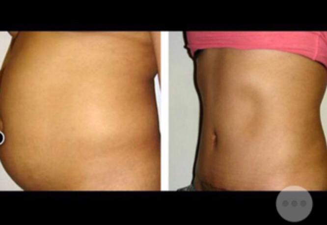This can be you!! #DrTaneja does amazing work. Come in for a FREE consultation! #plasticsurgery #cosmetics