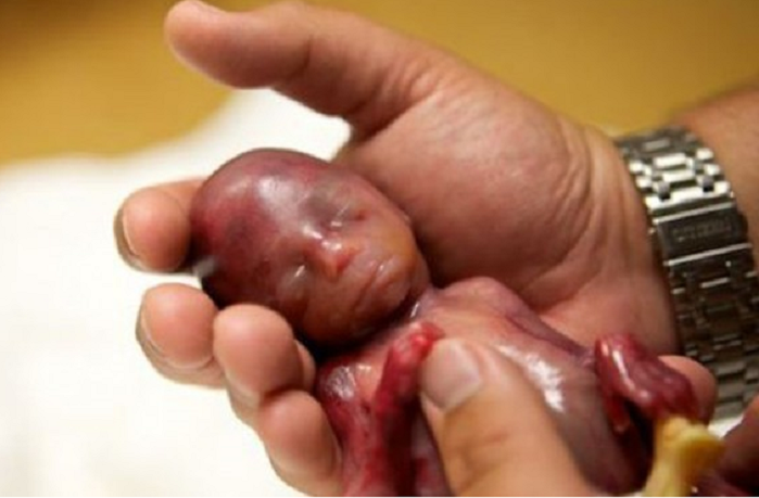The Life and Death of Baby Walter is Changing The Abortion Debate buff.ly/19on6ZD
