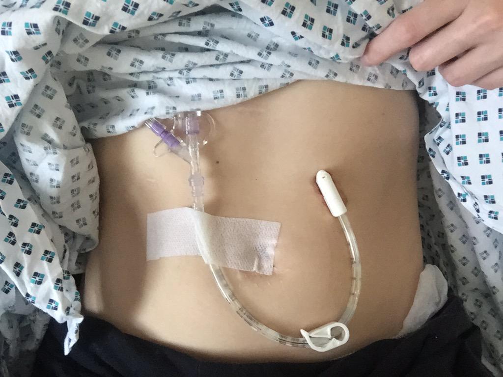KToogie's tweet photo. Meet my new PEG, I've named him Pegasus, the White stallion of salvation #CysticFibrosis #pegfeed #missionweightgain http://t.co/aJ3sd5uaPJ