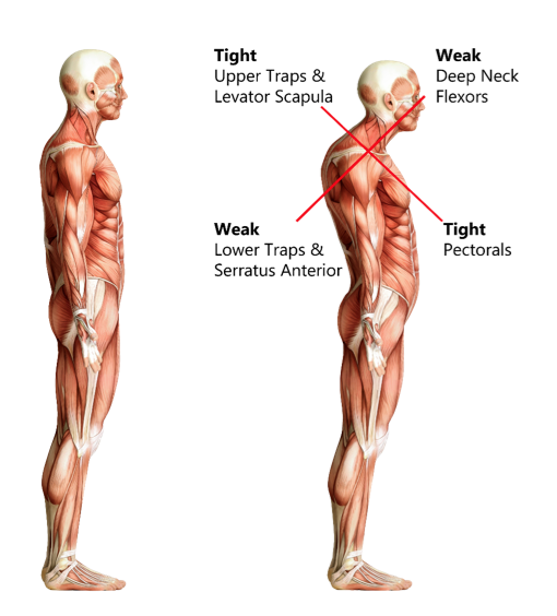 MyTPI's tweet photo. Upper Crossed Syndrome is common among desk-bound workers. It's evidenced by rounded shoulders &amp; hunched upper back. http://t.co/vaOBfv47MW