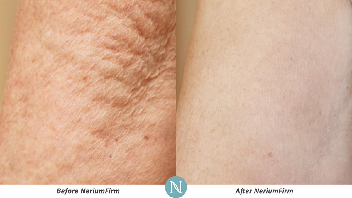 LisaLiveClean's tweet photo. NeriumFirm can help you firm up for that upcoming special occasion. http://t.co/MSA4XLKyDU
