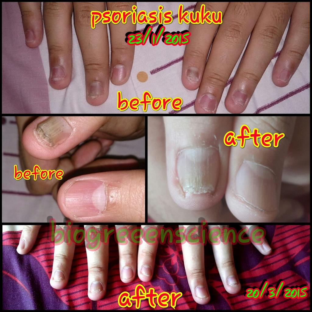 psoriasis kuku