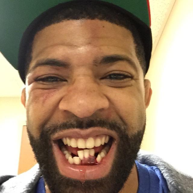 Ariel Helwani On Twitter Man Rt Golrawsport The Good News Is Lc Davis Can Get These Teeth Fixed Or Take Up A New Career In Hockey Http T Co Ahl6mnusez