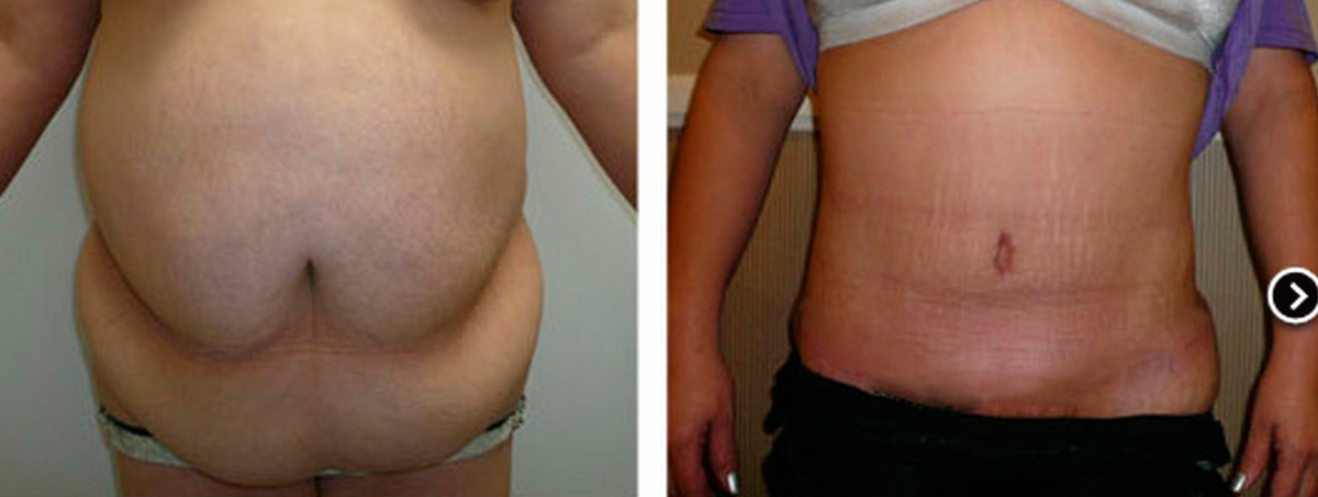 This is REAL before &amp; after! Call Dr. T and let #MyLook help you!!! 877-7-MYLOOK #lipo #plasticsurgery