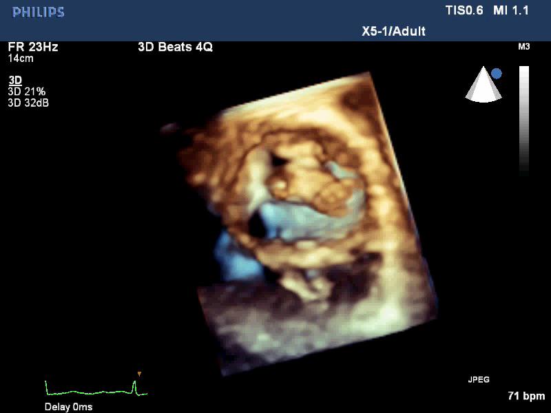 TufekciogluOmac's tweet photo. @lpbadano Two new images, one is systole and other one at the end of diastole,
2D is the answer http://t.co/vCKYL2xd9c