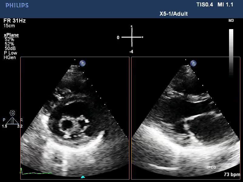 TufekciogluOmac's tweet photo. @lpbadano Two new images, one is systole and other one at the end of diastole,
2D is the answer http://t.co/vCKYL2xd9c