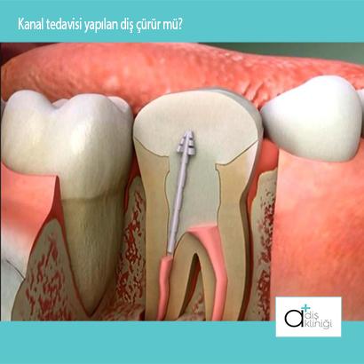 Tedavi gören dişlerin diğer dişlerden farkı yoktur.Dolayısıyla kanal tedavili dişlerde çürüyebilir.