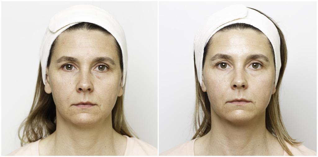 ApolloSpa's tweet photo. No lies, no photoshop magic. Just the science and technology. Before and after #apollospa #endermolift #HydraFacial http://t.co/8jgcBUcmDX