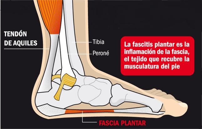 medueleelpie1's tweet photo. Corredores y bailarines son más propensos a padecer fascitis plantar https://t.co/vMKgJVVc0W https://t.co/tVKxeY5xZG