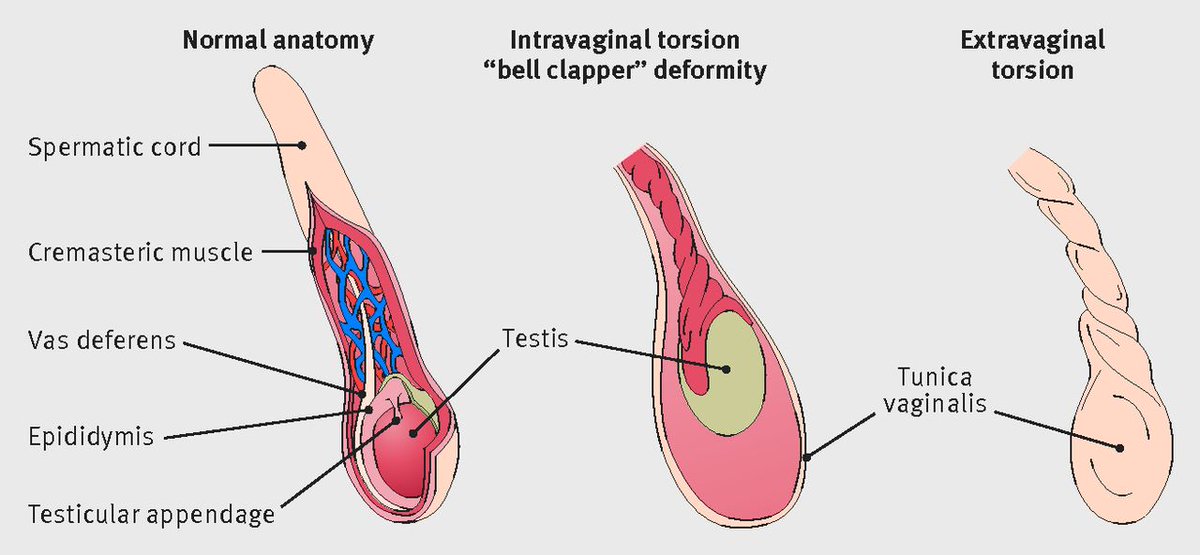 Testicle Injuries Intermittent Testicular Torsion