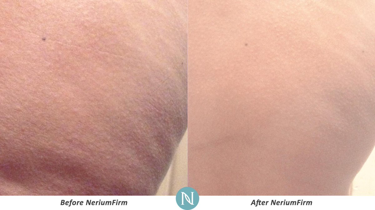 LisaLiveClean's tweet photo. The Real Results of NeriumFirm will be noticed by everyone. http://t.co/VsZN7fg9lm