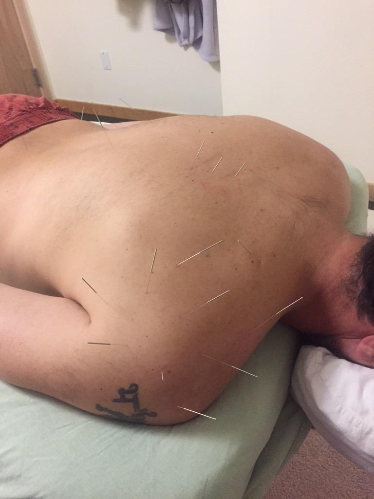 Element6Boulder's tweet photo. Snowboarding injury, after 1 sesh rotator cuff injury 80% improved! #acupunctureheals #acupuncture #element6boulder http://t.co/40teQbHfyJ