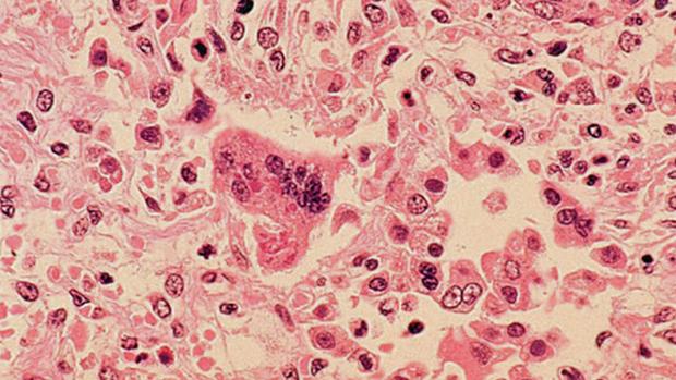 CTVVancouver's tweet image. Student at Lord Byng Secondary School showing measles symptoms, officials confirm: bc.ctvnews.ca/suspected-meas…