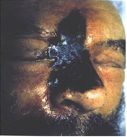 Pearls4IMBoards's tweet photo. Rhinocerebral mucormycosis

Rapid fatal infection
Finding Black necrotic tissue on nose/palate is pathognomonic http://t.co/CO6Z9CNhPZ