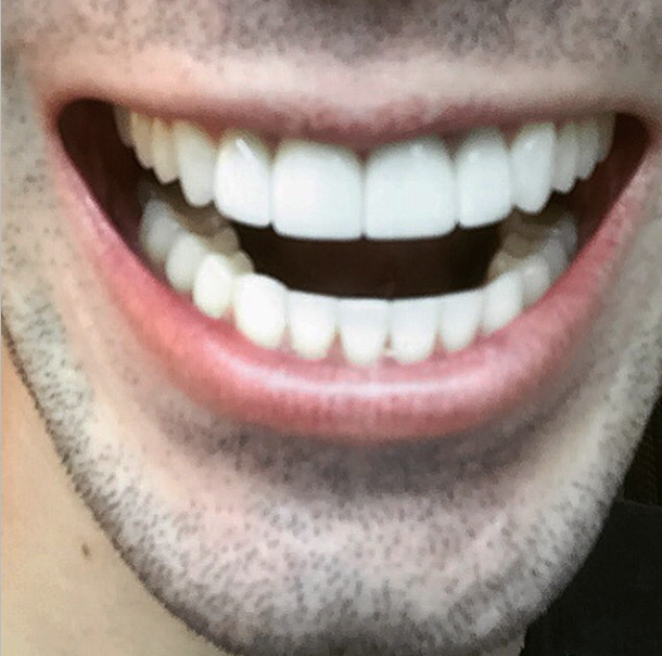 LansWDental's tweet photo. Nice! "@Invisalign: "Had my final appointment today! Thanks for giving me a reason to smile!" -- @wytlerwest http://t.co/F5ZJICJT0K"