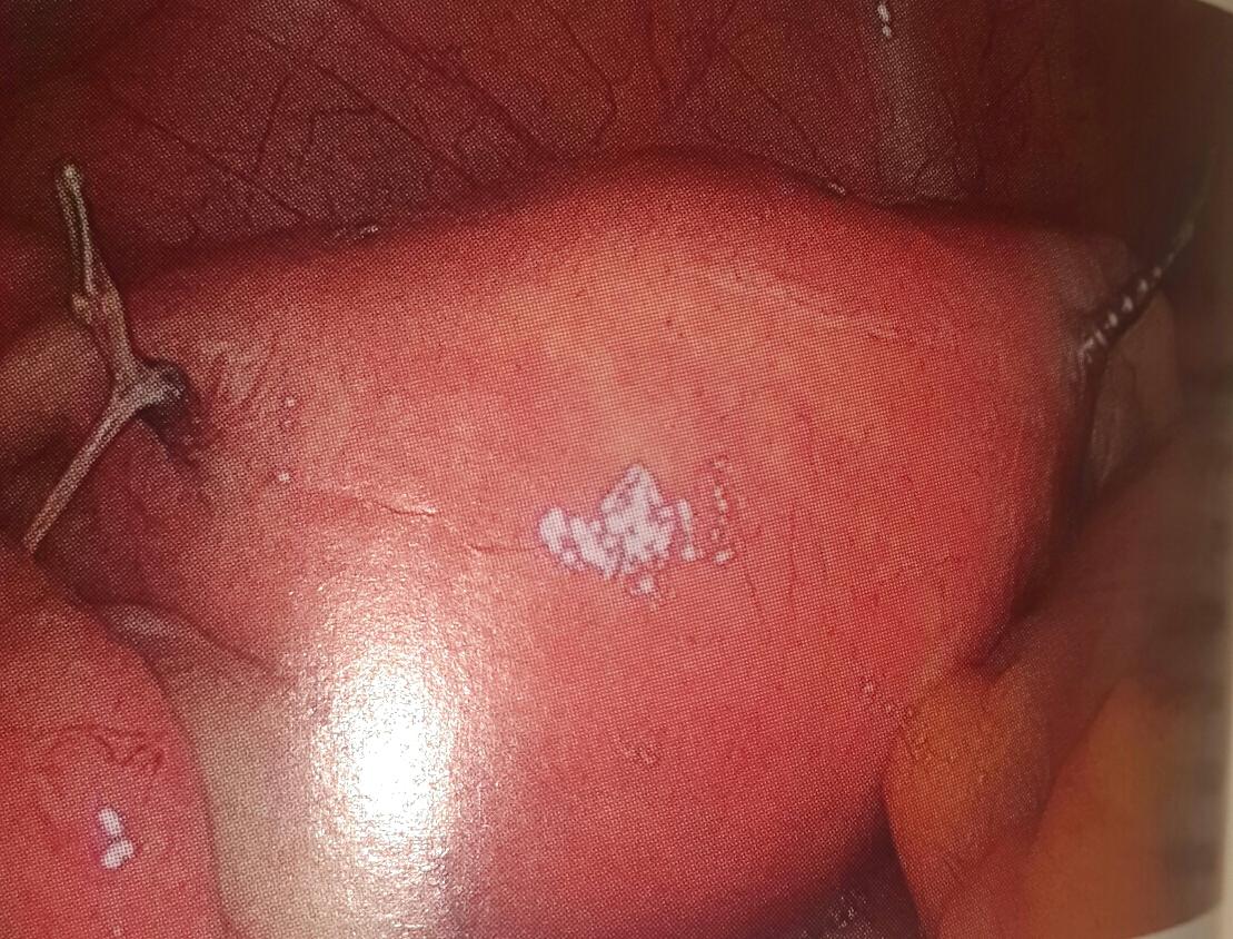 libreessure's tweet photo. NO podemos operamos : 
"a petición de la paciente"

Nos operamos porque #essure nos hace daño,
 tenemos efectos secundarios adversos
Porqué cometieron un error y ahora deben repararlo
@AEMPSGOB
@sanidadgob
(Essure) perforando el útero a nivel de lo cuernos https://t.co/ja5Mos1uO6 https://t.co/iaYnRcmBU0