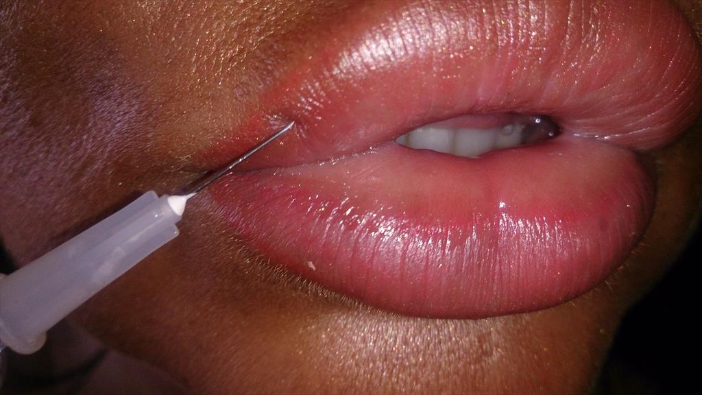 KrystinaButel's tweet photo. New mouth all done #plasticsurgery @FillersPositive #lipfillers #hyaluronicacid #fillers #iloveplasticsurgery http://t.co/coPbnW0JLA