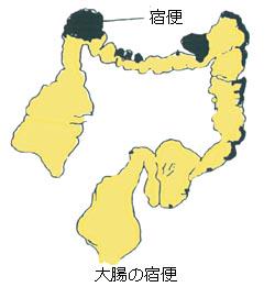 fasting_info's tweet photo. 宿便とは…？
腸内にへばりついて出し切れなくなった便です。
便秘や肥満等、万病の原因です。
腸内環境を整えることで、劇的に健康になります。
【豆知識】脳を移植するよりも、腸を移植するほうが人格変化に影響が出ます。 https://t.co/soT87vKGW1