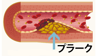 fasting_info's tweet photo. 【プラーク】悪い食習慣により溜まってしまった、血管内の汚れです。
年齢を重ねるごとに詰まっていき、脳血管疾患、心疾患等様々な生活習慣病を生み出します。
血管を整えると腸内環境も良くなります。
注目：L-アルギニン、ファスティング https://t.co/4KWerWiKHb