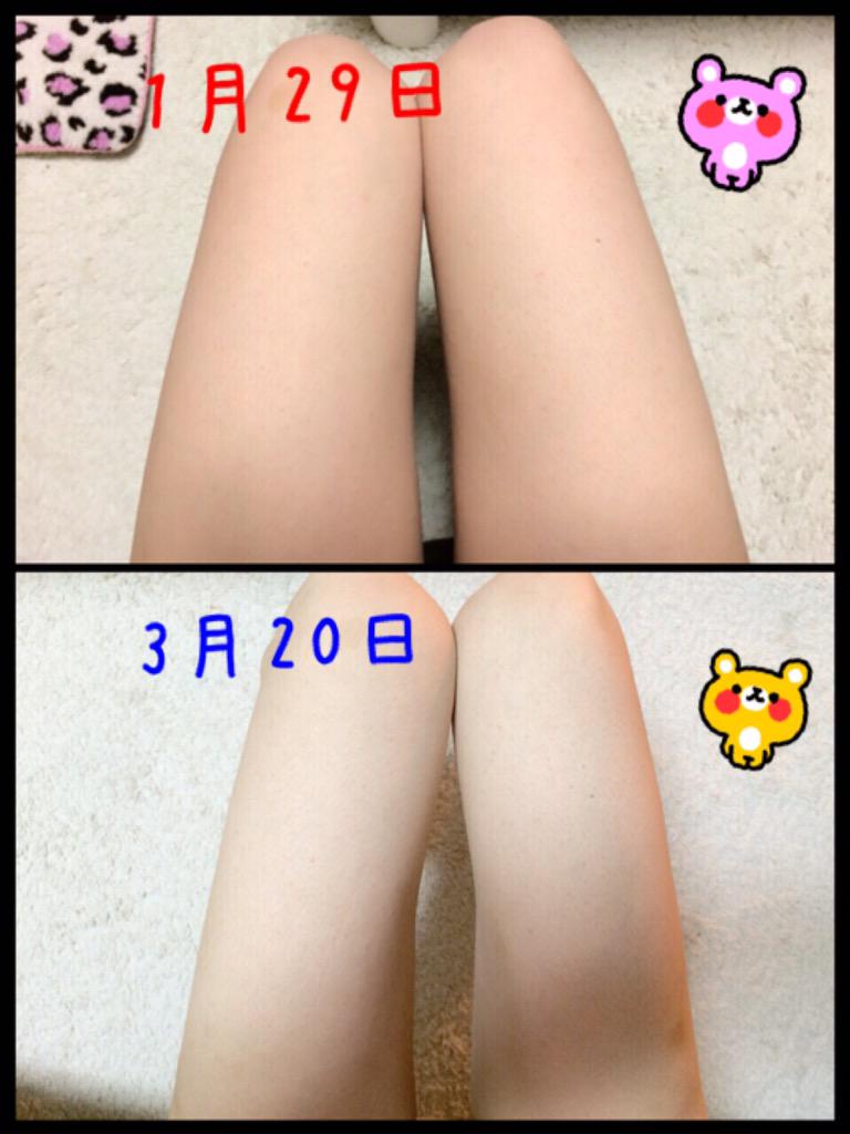 ゆぴ Twitterren リファ Amp ボニックの成果 ダイエット仲間募集 脚痩せしたい人rt ダイエッターさんと繋がりたい Rtした人全員フォロー Http T Co Rxr0o6ziho Twitter