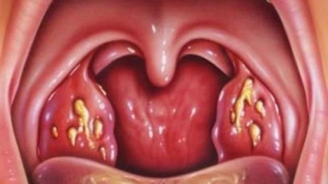SwagActu's tweet photo. Comment se débarrasser de maux de gorge en moins de 4h ? 
Réponse ici > http://t.co/63w6sk7E2I http://t.co/94lFyFrPvO