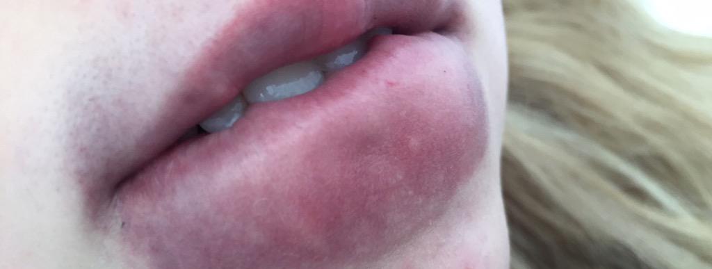 disconiamh's tweet photo. I TRIED THE KYLIE JENNER LIP THING, DO NOT DO IT, I FOUND OUT THE HARD WAY http://t.co/BuBJU6u4Ck
