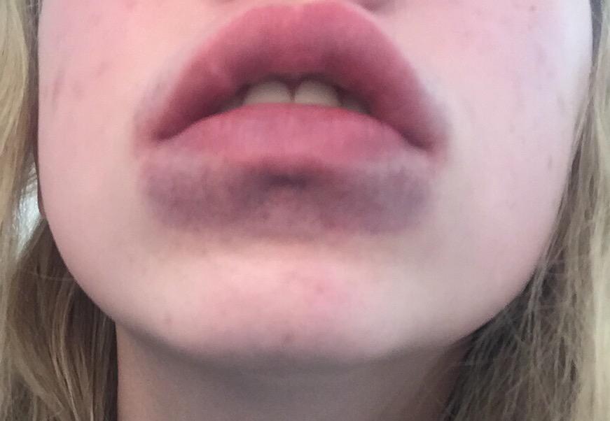 disconiamh's tweet photo. I TRIED THE KYLIE JENNER LIP THING, DO NOT DO IT, I FOUND OUT THE HARD WAY http://t.co/BuBJU6u4Ck
