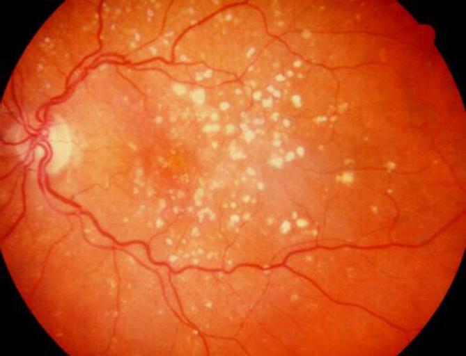 cellider's tweet image. #StemCells Injection Might Save Seniors From #Vision #Loss @CedarsSinai techtimes.com/articles/46676…