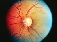 DBrettWilliams's tweet image. #Openangleglaucoma: Poor data for the fixed combination tafluprost/timolol ow.ly/LGtAl