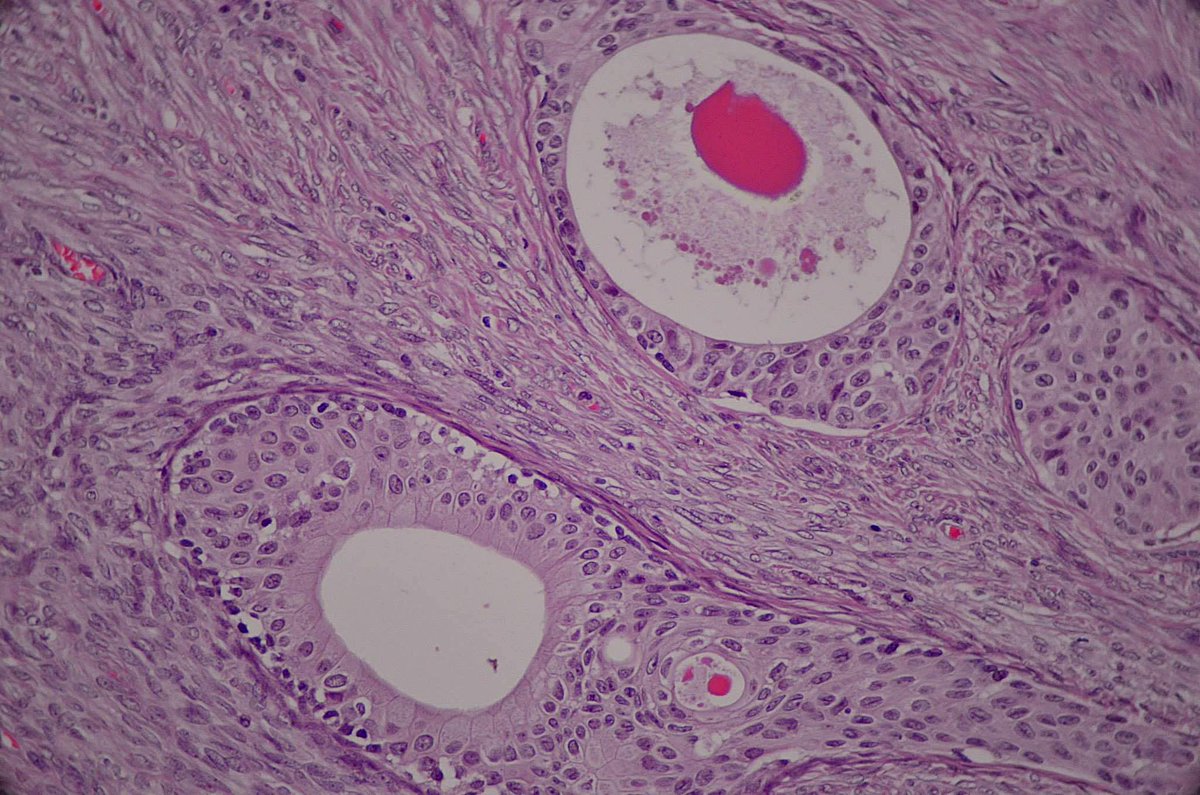 NejibY's tweet photo. Ovary, Brenner Tumor, Benign, Histo (HE), 2/2, #pathology http://t.co/6aKr7hyQ8S