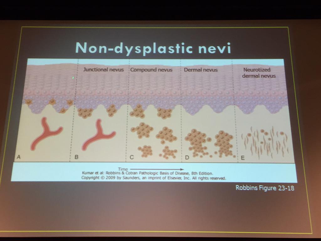 SkinCancerAR's tweet photo. Dr. Shalin @MightyDermPath explains typical common moles/Nevi at #ASCC15. #Dermpath #pathologists #dermatology http://t.co/aWyumCVs0h