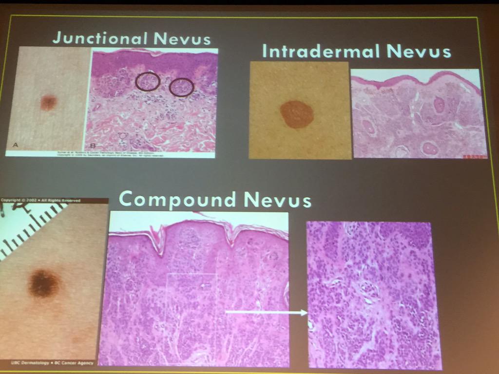 SkinCancerAR's tweet photo. Dr. Shalin @MightyDermPath explains typical common moles/Nevi at #ASCC15. #Dermpath #pathologists #dermatology http://t.co/aWyumCVs0h