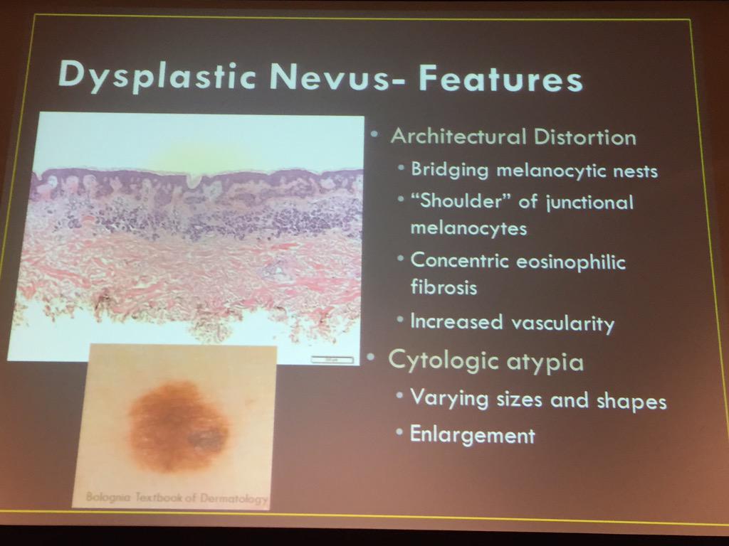 SkinCancerAR's tweet photo. Dr. Shalin @MightyDermPath explains atypical moles (dysplastic nevi) at #ASCC15. #Dermpath #pathologists #dermatology http://t.co/PF5SzjaK8o