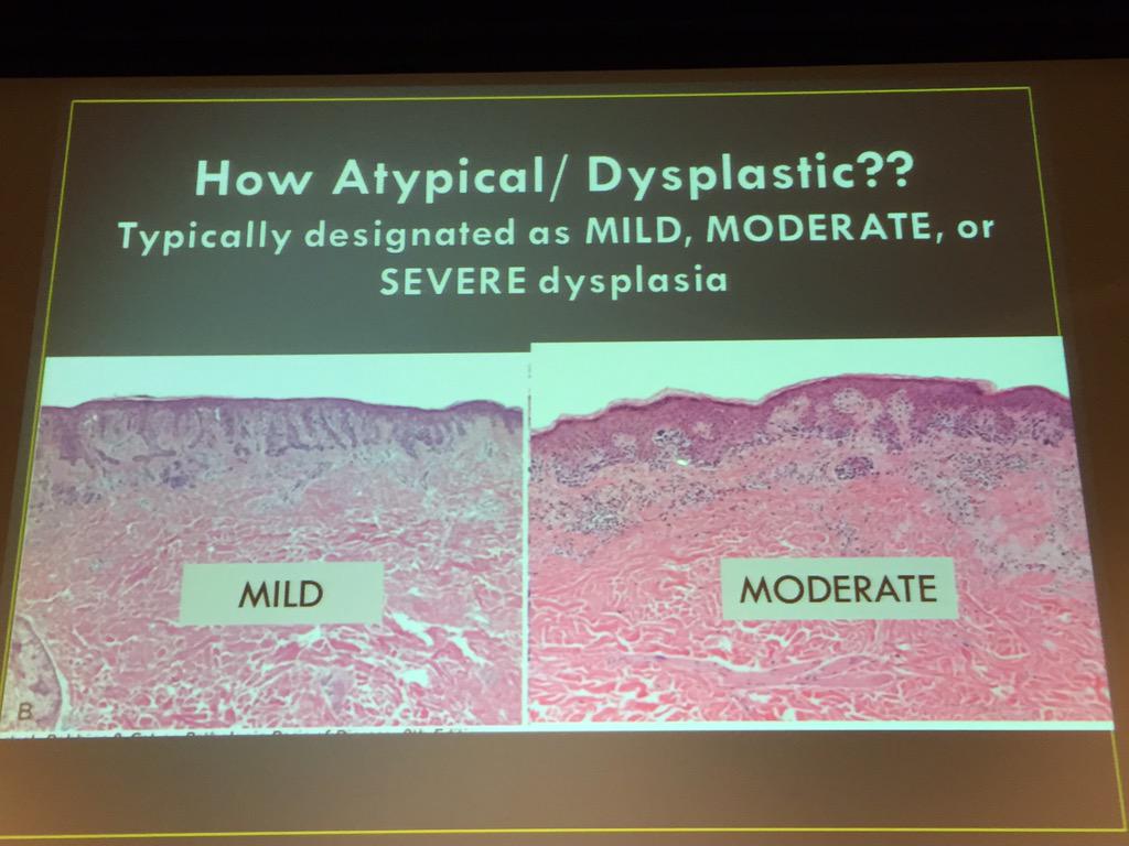 SkinCancerAR's tweet photo. Dr. Shalin @MightyDermPath explains atypical moles (dysplastic nevi) at #ASCC15. #Dermpath #pathologists #dermatology http://t.co/PF5SzjaK8o