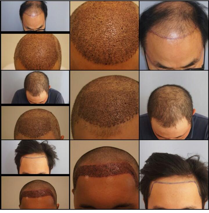 garg hair transplant (@garghairclinic) / Twitter garg hair transplant (@garghairclinic) / Twitter