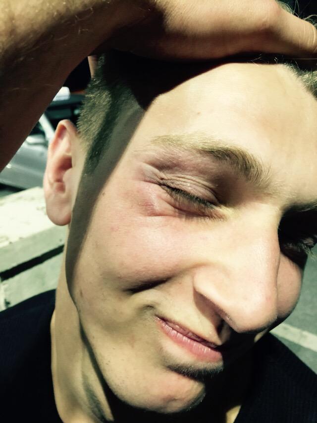 NalaPiper's tweet photo. Cliffy took a sucker punch last night @Cliff_walters http://t.co/YZ9y3VuXXJ