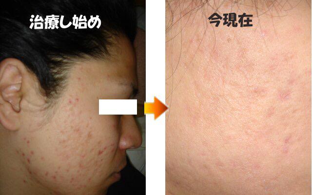 Ayaka ニキビ肌改善 Charliehana Twitter Ayaka ニキビ肌改善 Charliehana Twitter