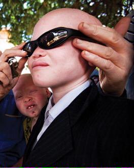 Join us on the 1 Angel Eyewear Campaign to collect  used and new sunglasses for kids with Albinism.

Be an Angel.