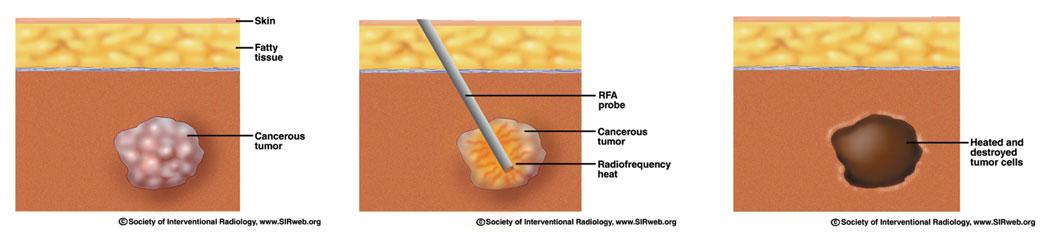 InterventionIQ's tweet photo. Radiofrequency ablation is one of IR’s most successful treatments (image: @SIRspecialists) http://t.co/IA4t2ux4Km http://t.co/GxUvSOQHDi