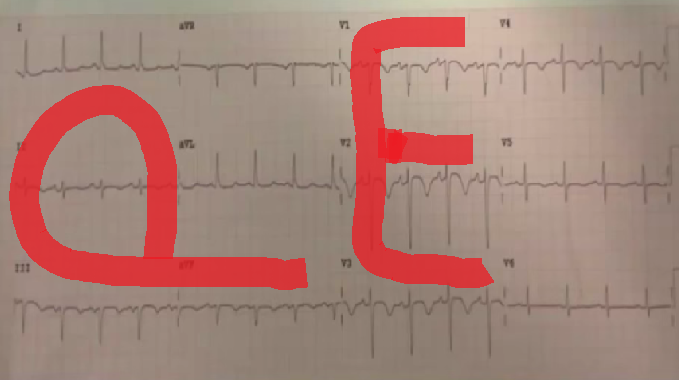 UCAirCareDoc's tweet photo. "TWI Inf+Anteroseptal= PE until proven otherwise" --@amalmattu https://t.co/PLPNKzLR81

Here's how I remember this: http://t.co/h1RjpKb4pY
